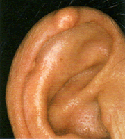 耳にできた痛風結節